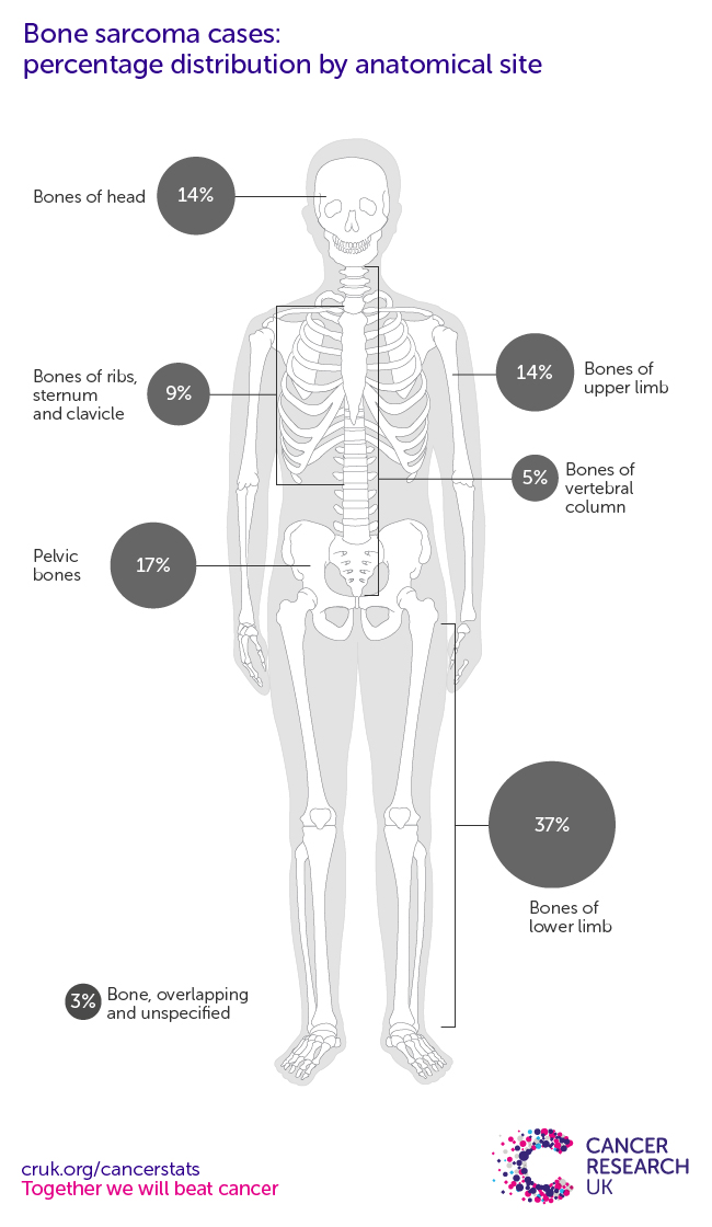 Anatomical image of bone sarcoma sites